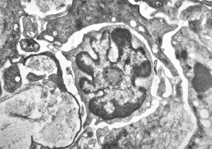 F, 36y. | Sézary-like cell - generalized eruptive histiocytoma F, 36y. | Sézary-like cell - generalized eruptive histiocytoma